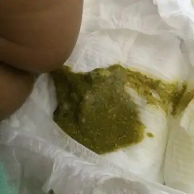 36kg,身高64,配方粉餵养,最近两周大便呈水样或蛋花汤样,每天1～3次